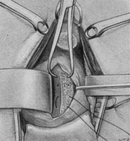 Historical technical image of the Hill-Sachs lesion