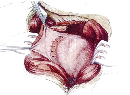 Historical operative diagram related to posterior shoulder dislocation