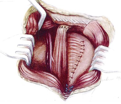 Historical operative diagram of the McLaughlin procedure