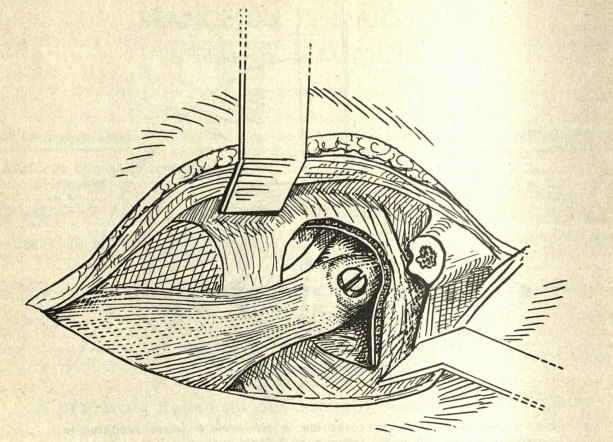 Historical diagram of the Bristow-Helfet procedure