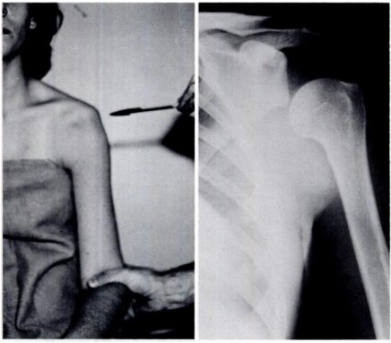Historical shoulder examination and radiograph illustrating multidirectional instability