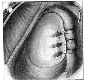 Historical soft-tissue anchor repair illustration