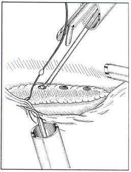 Historical arthroscopic soft-tissue anchor placement illustration