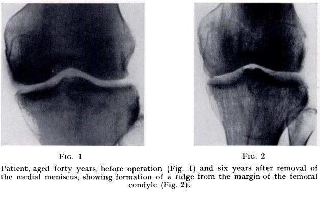 Fairbank radiographs before and after medial meniscectomy
