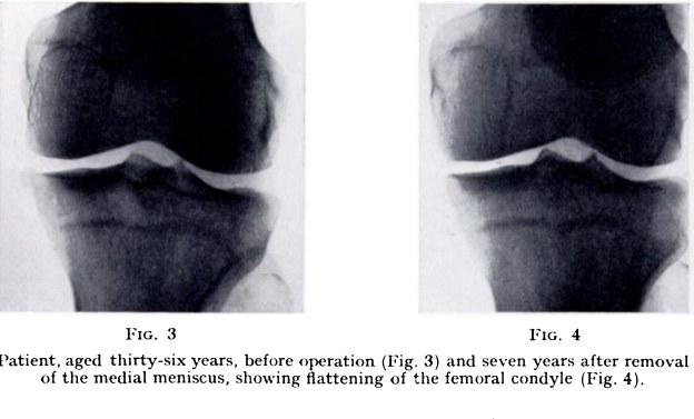 Additional Fairbank radiographs before and after medial meniscectomy