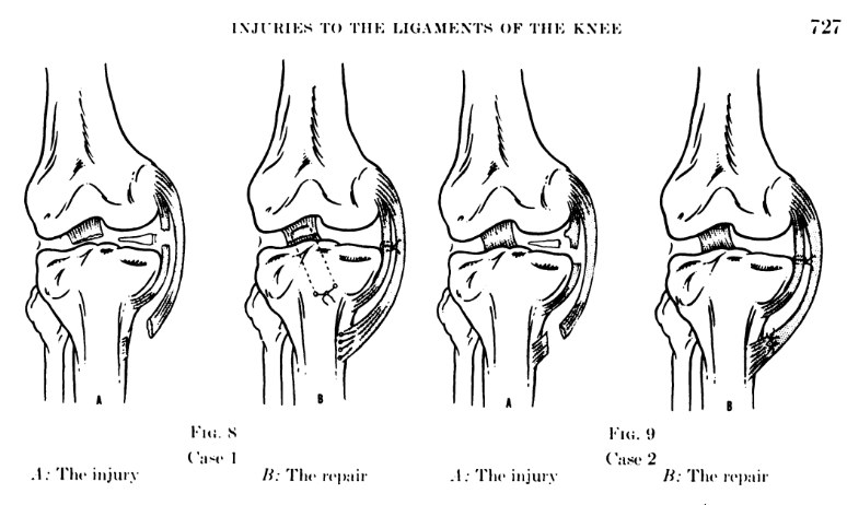 O'Donoghue's historical knee ligament injury and repair diagrams