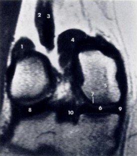 Coronal MRI of the knee with labeled anatomy